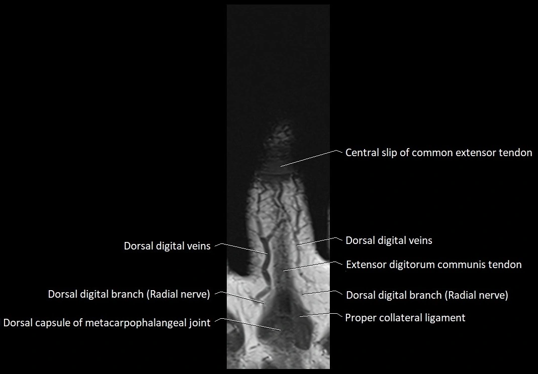 Finger anatomy coronal cross section 3TMRI labelled  image 2.webp